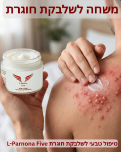 טיפול טבעי לשלבקת חוגרת